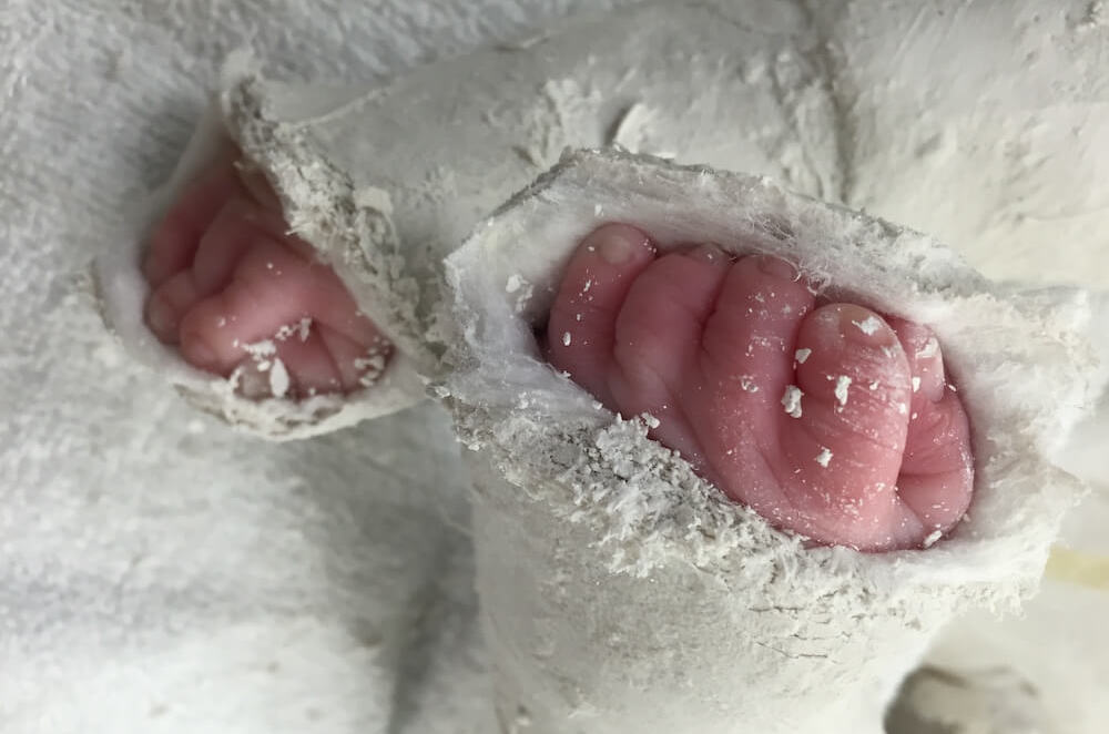 Toes poking out through ponseti casts that were used to help with arthrogryposis.
